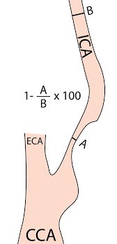 NASCET Diagram